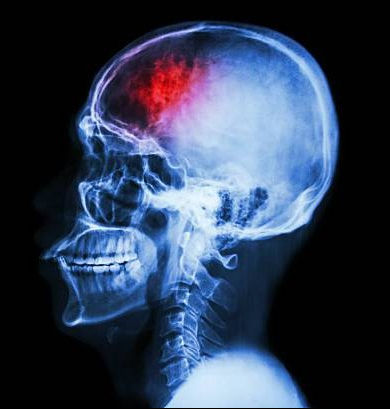 Menopause Increases Stroke Risk – Part 1
